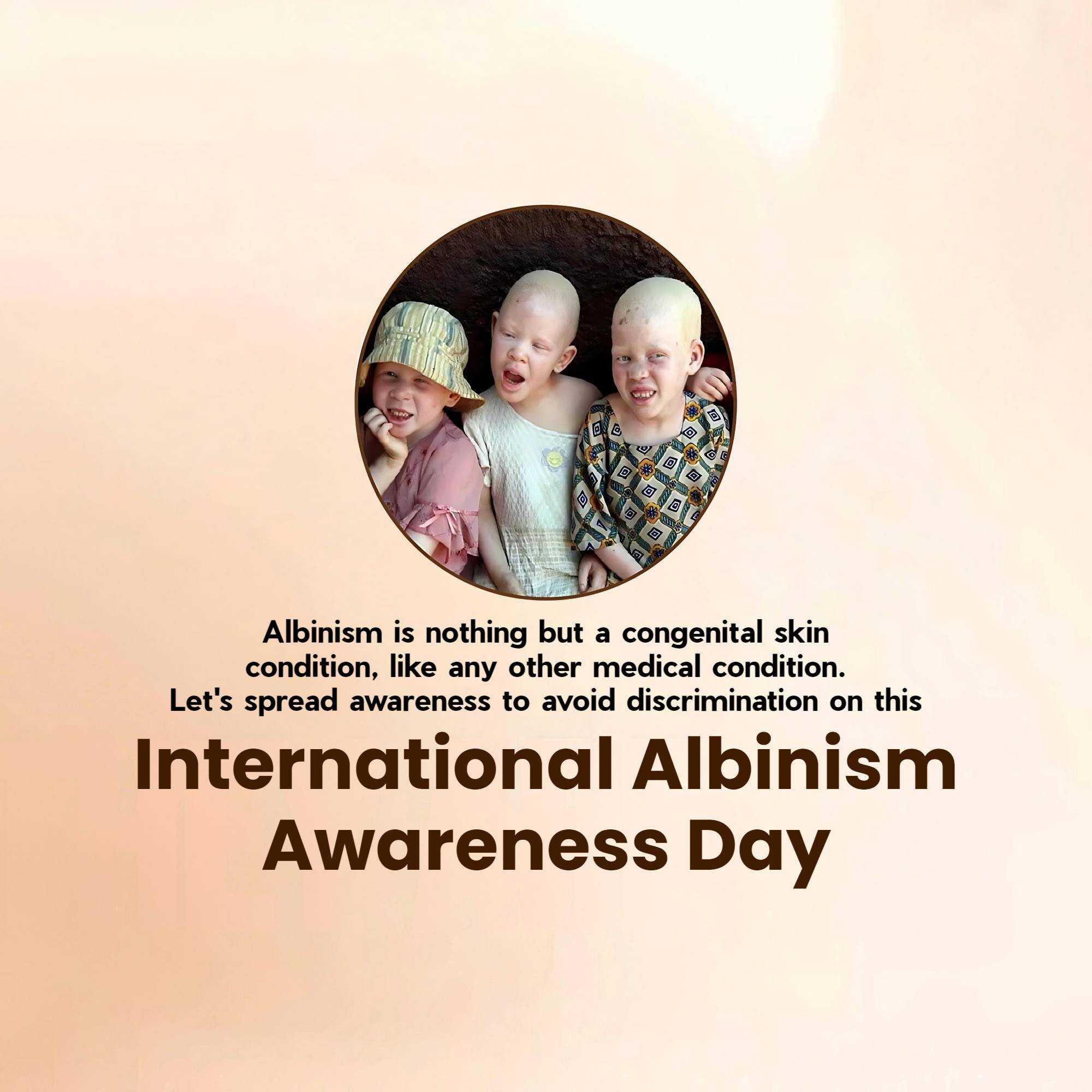 International Albinism Awareness Day
